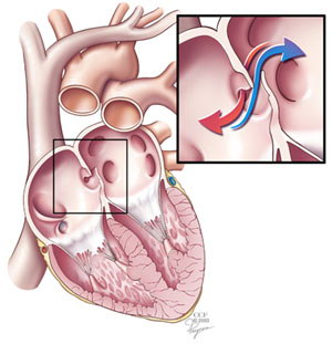 Анатомия незаросшего овального отверстия (с сайта www.clevelandclinic.org)